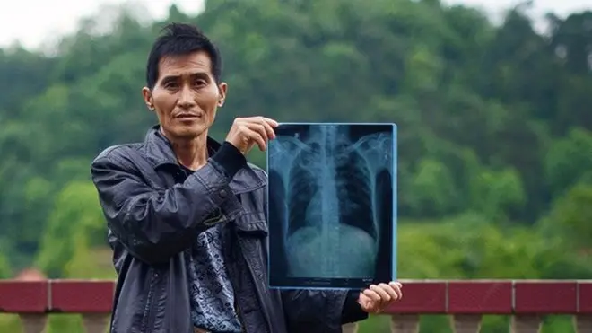 根据中国官方的数据，中国有超过70万尘肺病患者。（图为湖南的一名尘肺病患者，他曾是一名建筑工人）