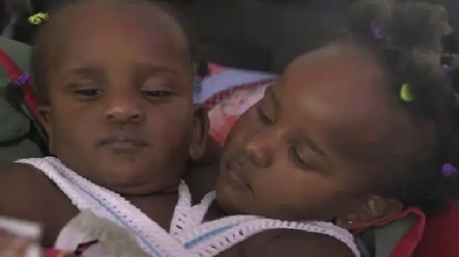 Sijamske bliznakinje