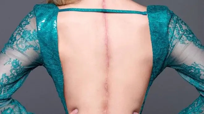 Спину Виктории пересекает длинный шрам