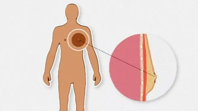 مردوں کے نِپل