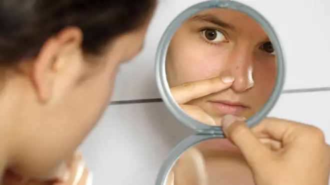 Para los que lo sufren, el acné puede causar problemas de autoestima.