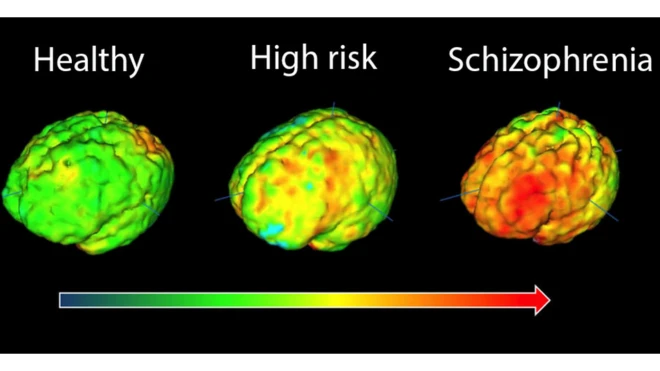 전문가들은 실험을 통해 조현병 환자에게 뇌의 피질 부피 감소와 같은 해부학적 이상을 포함해 각종 뇌 기능 이상이 발생하는 것을 밝혀냈다