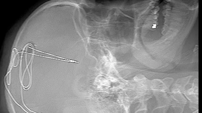 Radriografía de Gerod Buckhalter