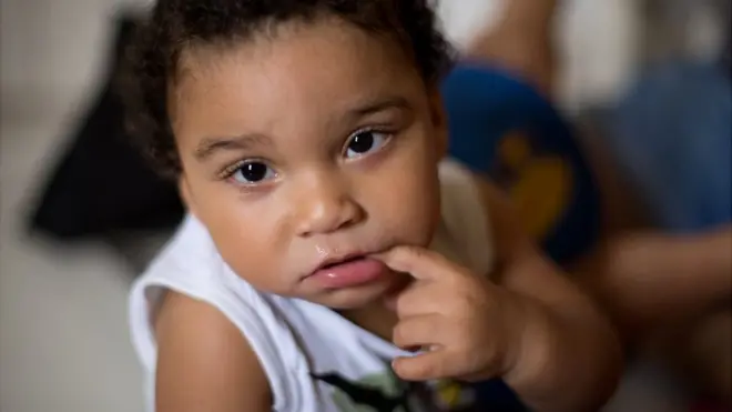 Con un año y medio, un bebé con un caso grave de Síndrome Congénito de Zika sorprende a padres y médicos.