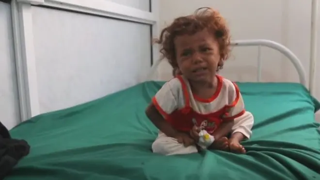 내전과 기아로 고통받는 예멘의 어린이