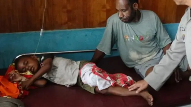 15 pasien akibat gizi buruk dan campak kini masih dirawat di RSUD Agats.