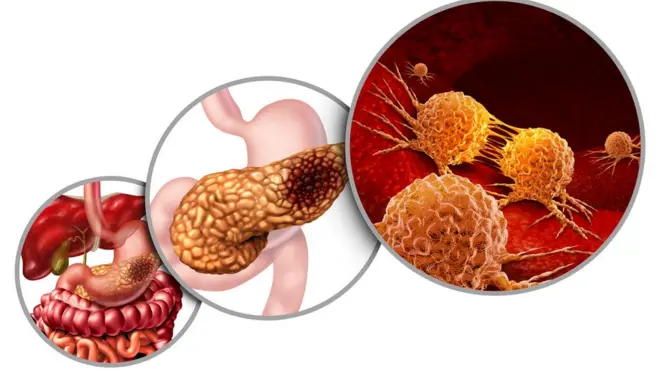 विष्ठेची तपासणी करुन स्वादुपिंडाचा कर्करोग पहिल्या टप्प्यातच शोधता येणं शक्य