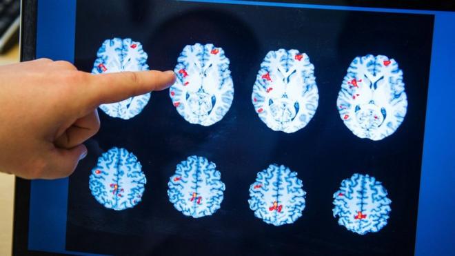 درمان سرطان مغز