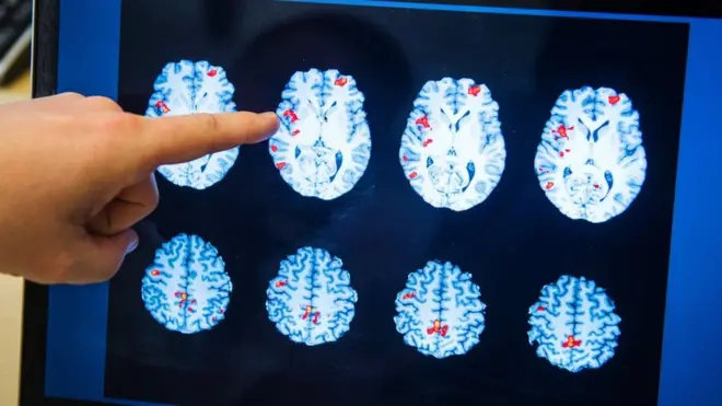 درمان سرطان مغز