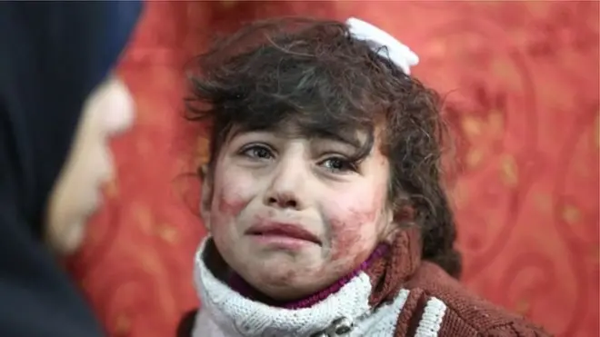 સીરિયાના હુમલામાં ઘાયલ થયેલી બાળકીની તસવીર