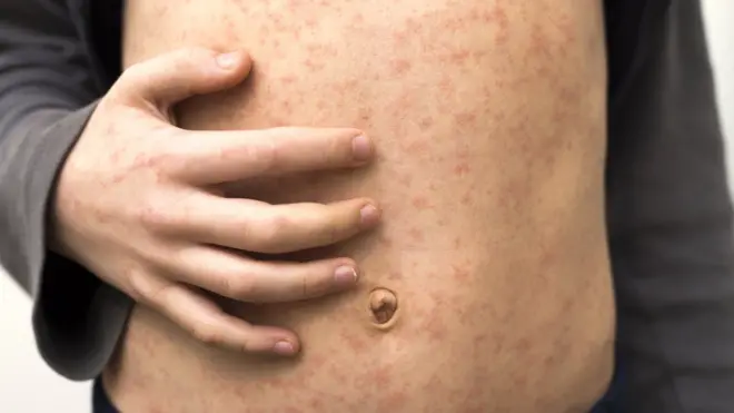 Measles rash