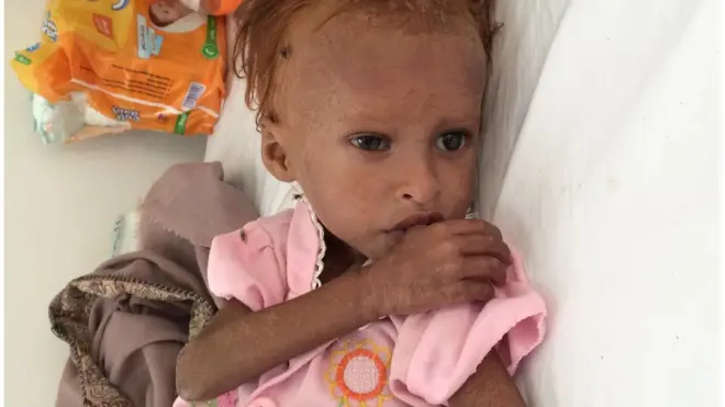 تبلغ حميدة حمدي من العمر ثلاث سنوات، وتعاني من سوء تغذية حاد.