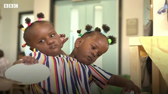 샴쌍둥이 분리수술