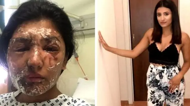 ریشم خان اور ان کے کزن جمیل مختار پر گاڑی کے شیشے سے تیزاب پھینکا گیا جس کے باعث وہ بری طرح جھلس گئے