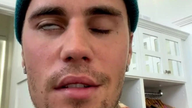 Bieber revealed his condition on 10 June via an Instagram video