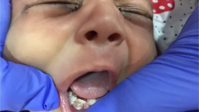 الأسنان اكتشفت بعد أيام من ولادة الرضيع