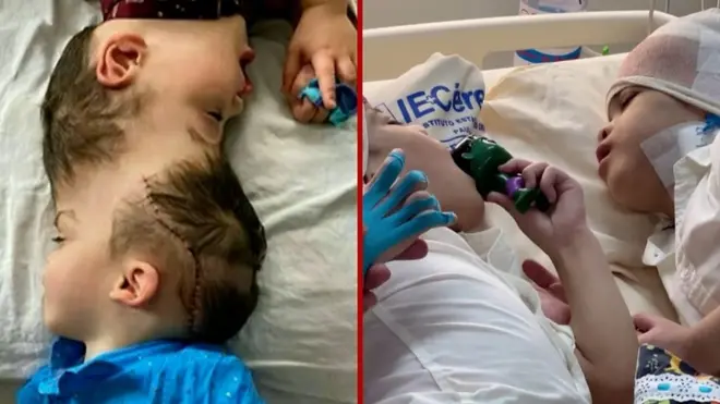 ”Ovo je čudo”: Sijamski blizanci vide jedan drugog prvi put