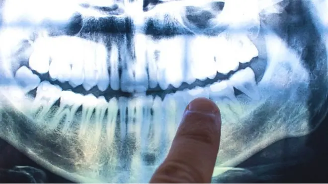 рентгенограмма десен