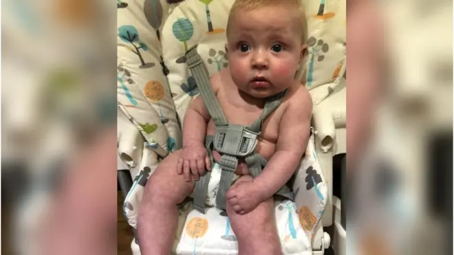 تعرض جورج لبقع جلدية، وانتفاخ في شفتيه، وارتفاع درجة الحرارة، ولم يكن بإمكانه الاحتفاظ بالسوائل في جسمه