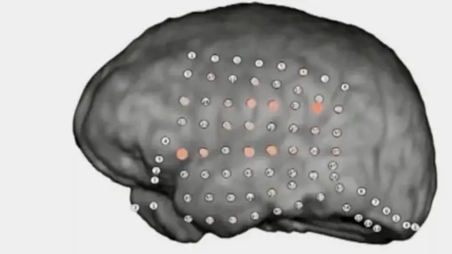 مناطق النشاط في الدماغ تضيء عند فهم الإنسان وإدراكه لمعاني الكلمات والجمل التي يسمعها في بيئة مشوشة