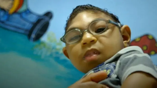 Bebé con microcefalia