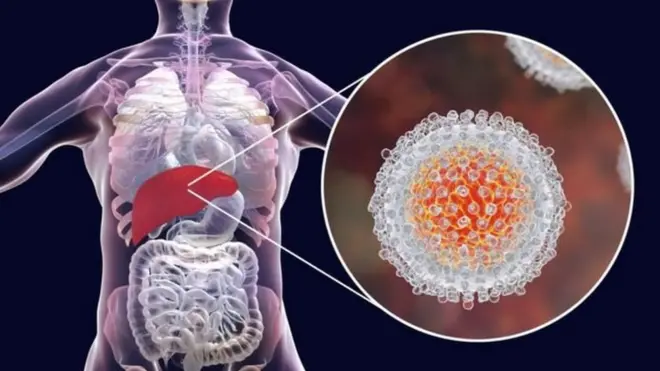 Karaciğerdeki Hepatit C virüsü