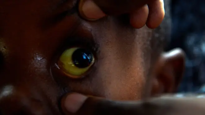 Anya onye na-arịa ọrịa ọbara nko