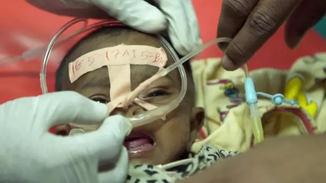 Дитина під'єднана до саморобного апарату штучної вентиляції легенів.