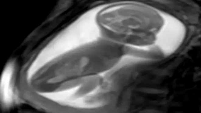 Baby in the womb