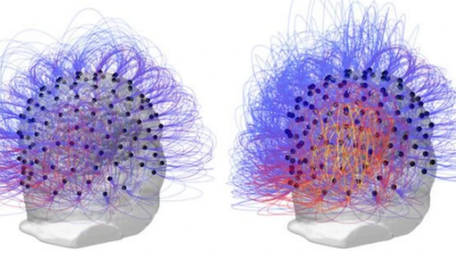 The scan shows the man's brain activity before (L) and after (R) the treatment