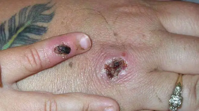 جدري القرود