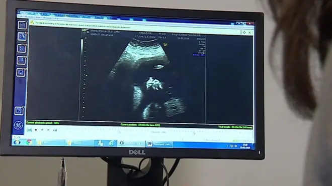 په بریتانیا کې ډاکترانو د هغه ماشوم چې لا هم د مور په رحم کې و، د ملا د تیر عملیات کړې دي.