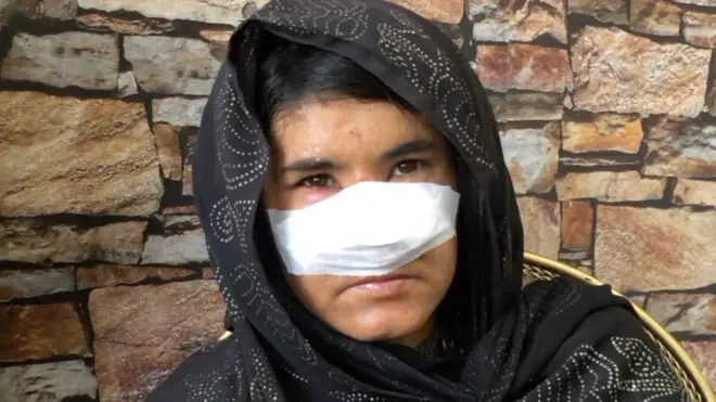 اعتدى زوج زاركا عليها وقطع أنفها بسكين جيب