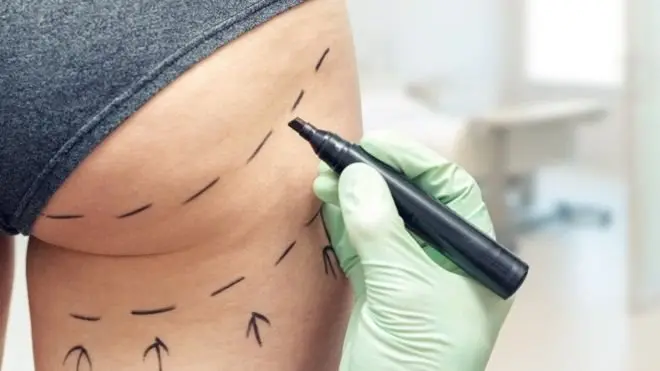 Kalça operasyonu yaptıracak bir kadın