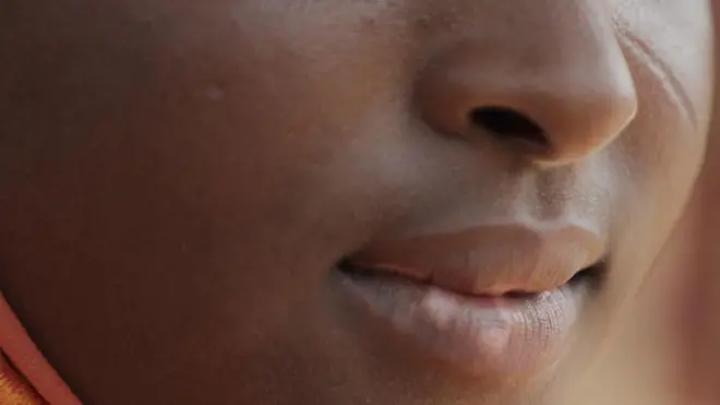 Gros plan du nez et de la bouche de la jeune fille, montrant des marques plus claires sur ses lèvres