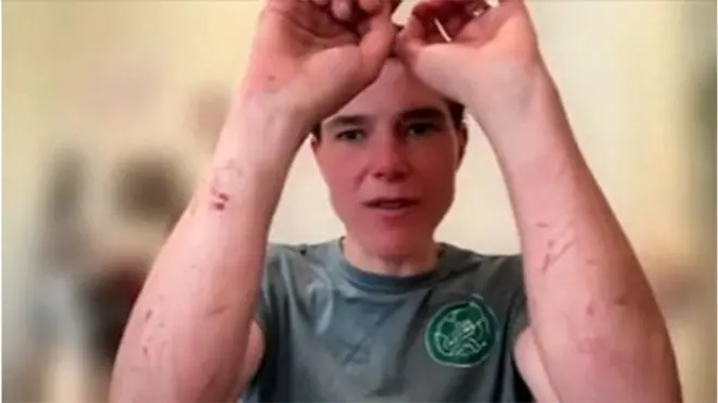 BBC와의 인터뷰에서 레이스 도중 팔에 생긴 상처들을 보여주는 패리스