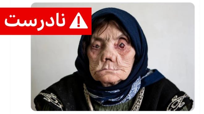 صورت زنی مبتلا به جذام