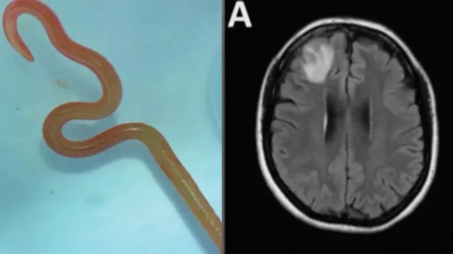 worm in australian women brain