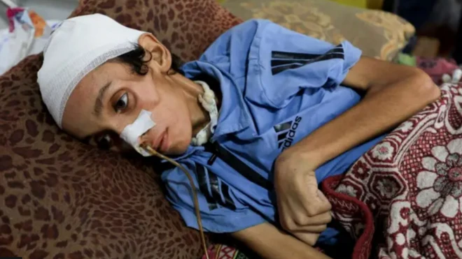 Həkimlərin qidalanmadığını bildirən 14 yaşlı fələstinli oğlan çərşənbə axşamı Qəzzada Əl-Şifa xəstəxanasında çarpayıda çəkilib.