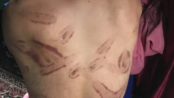 કાશ્મીરી યુવકની પીઠ ઉપર ઈજાનાં નિશાન