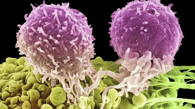 دراسة تؤكد أن الخلايا السرطانية التي تصيب الرئتين تتحرك بحرية في الجسم بعد انهيار السطح الخارجي لها وإفلاتها من المراكز التي تُثبت بها لتصيب أجزاء أخرى في الجسم.