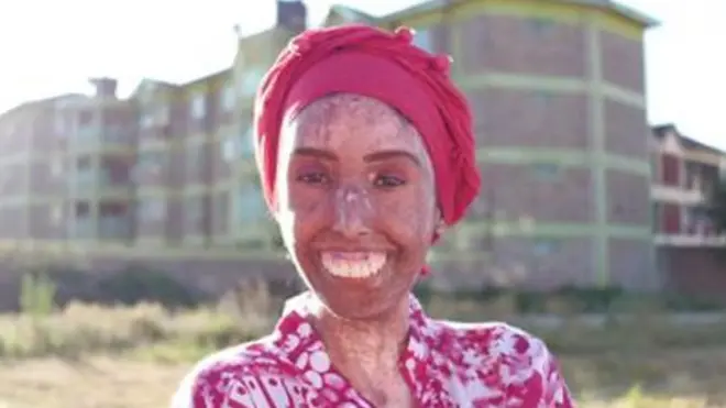 تعاني فرح خالق من تصلب الجلد، أحد أمراض المناعة الذاتية التي تسبب تصلب وشد الجلد والأنسجة الضامة، وهو حالة نادرة وغير قابلة للشفاء.