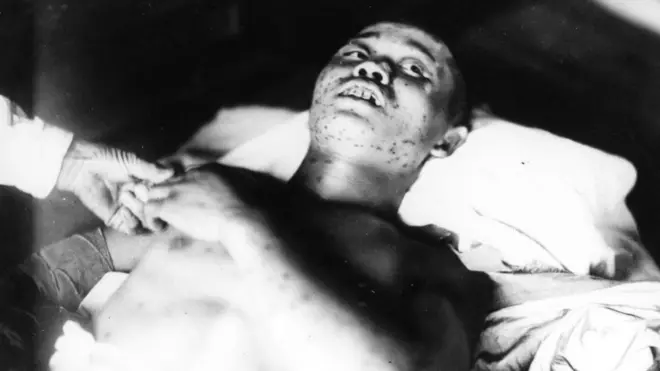 جندي شاب في الحادية والعشرين من عمره أصيب بنزيف تحت الجلد في جسده جراء القصف