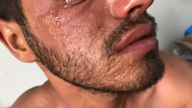 بي بي سي حصلت على صور تظهر أفرادا من الشرطة الفيدرالية العراقية في الموصل يعانون من حروق جلدية.