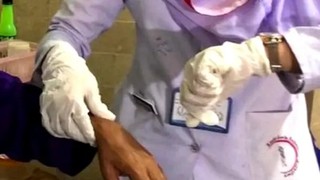 کوہی گوٹھ ہسپتال کراچی، فسٹیولا