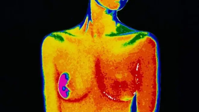 ምርመራ ካንሰር