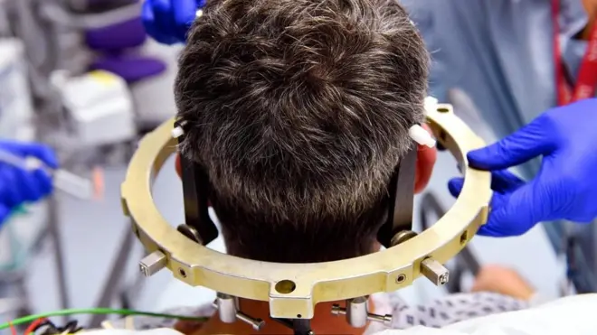 مريض حول رأسه أقطاب كهربائية