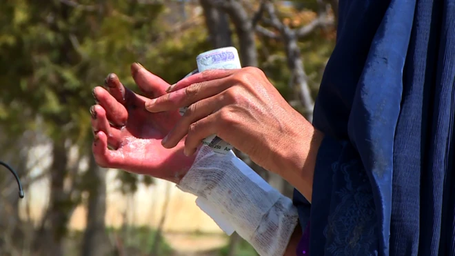 ډېری روغتیايي مرکزونه ان د معمولي سوځېدنې د درمللو توان نه لري