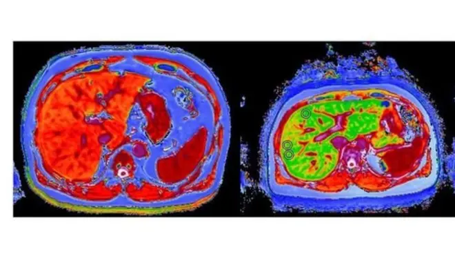 左右肝臟對比，左邊的病肝以及右側健康肝臟