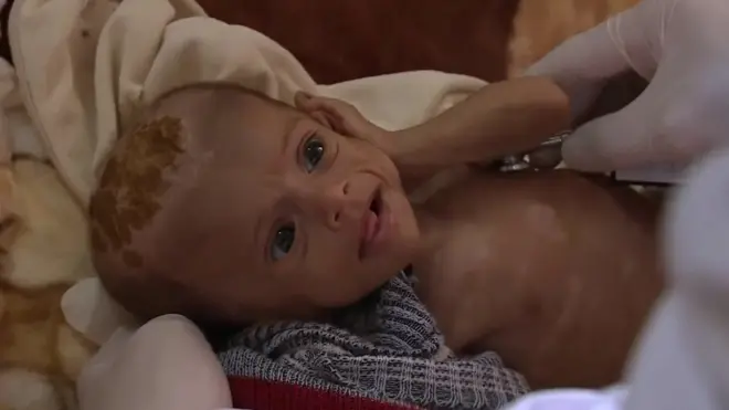 Caruurta Yemen oo ay haysato nafaqadarra ba'an